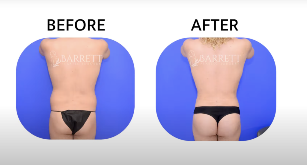 What's the Difference Between Female BBL and Male BBL?🙋🏻‍♂️🙋🏼‍♀️ -  Brazilian Butt Lift Guide