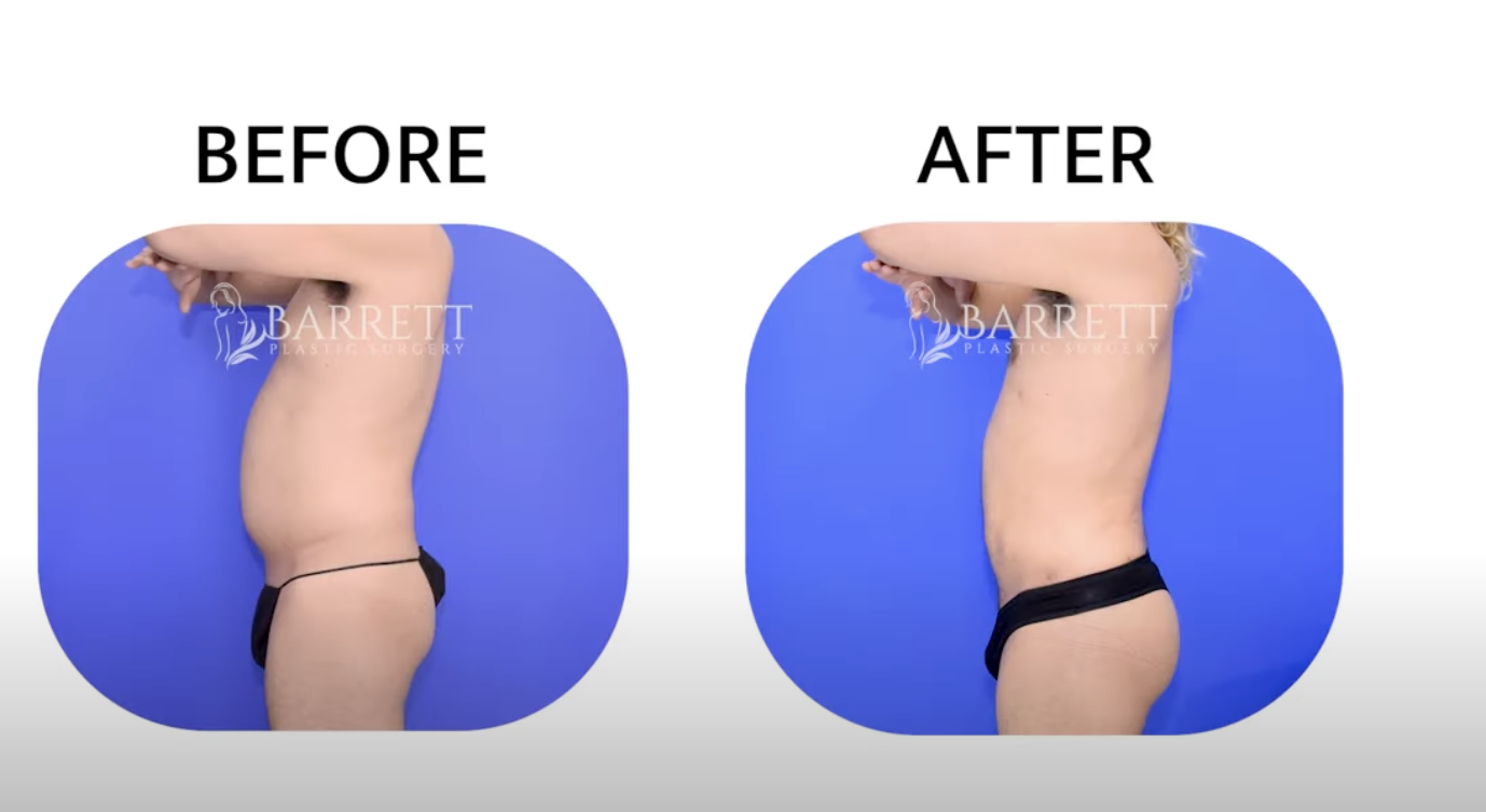 The Ultimate Guide to Buttock Lift Surgery with Dr. Barr