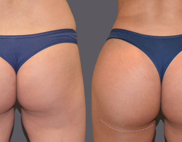 How To Choose Between A BBL And Glute Implants