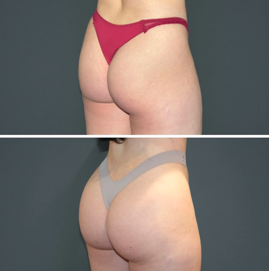 Brazilian Butt Lift: 1-year post cosmetic surgery - Cosmos Clinic